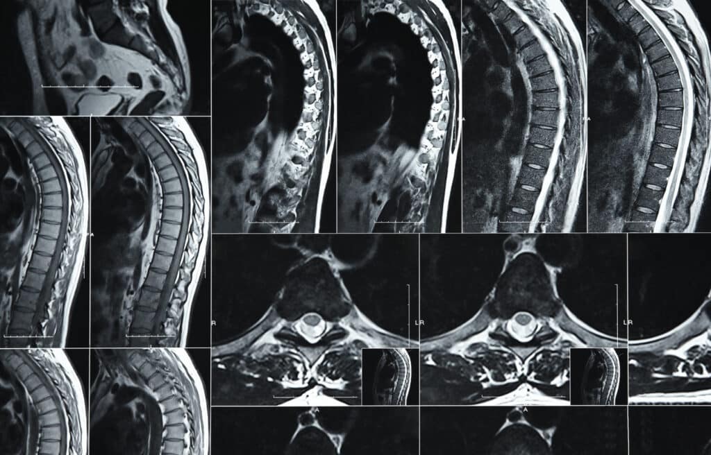 A grid of spinal MRI scans showing multiple sagittal and axial views